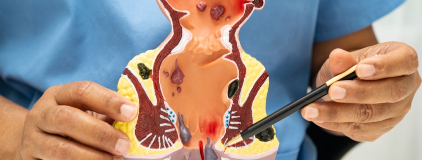 Αιμορροΐδες: Μια πάθηση πιο συχνή απ’ όσο νομίζουμε 1 αιμορροΐδες