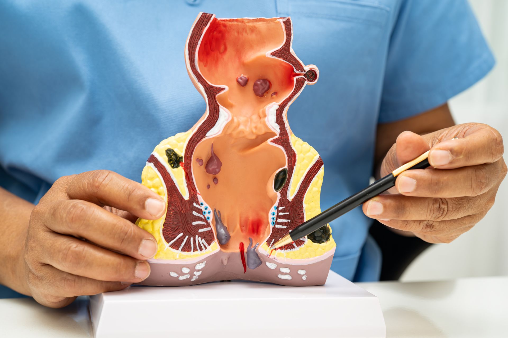 αιμορροΐδες