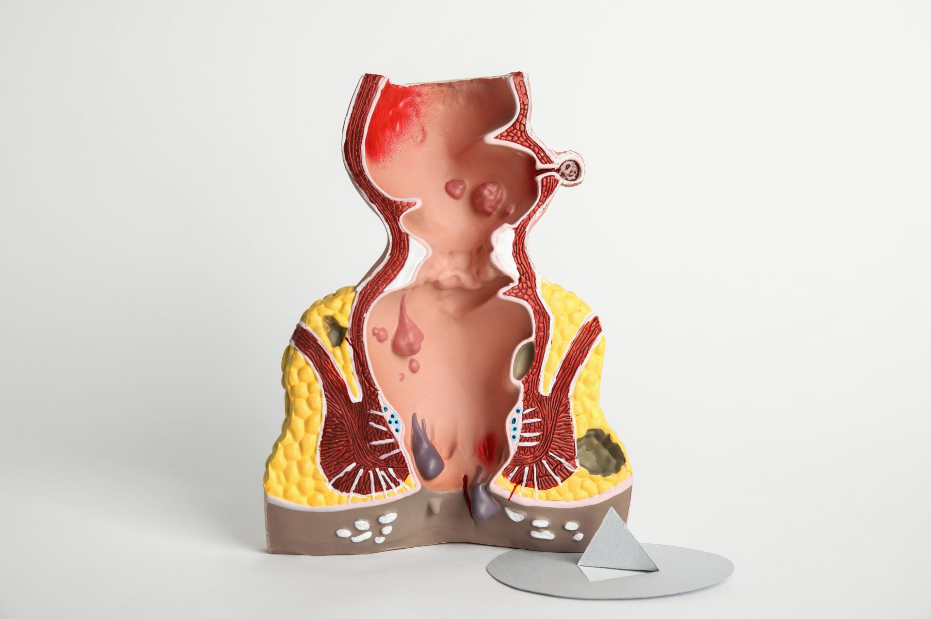 Αιμορροΐδες αίτια