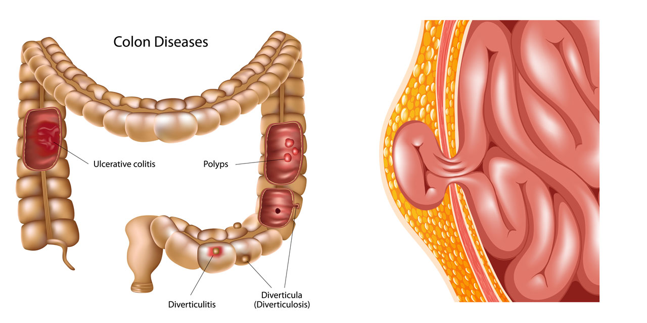 Medicacion para diverticulos