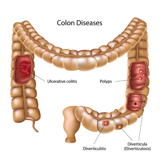 Diverticulitis vs. Ulcerative Colitis: 5 Differences To Know