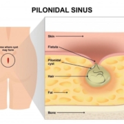 κύστη κόκκυγος