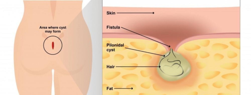 Κύστη κόκκυγος: Όσα πρέπει να γνωρίζετε για τη σύγχρονη αντιμετώπιση και την οριστική λύση 1 κύστη κόκκυγος