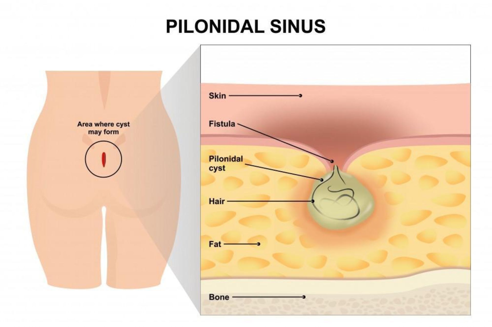 κύστη κόκκυγος