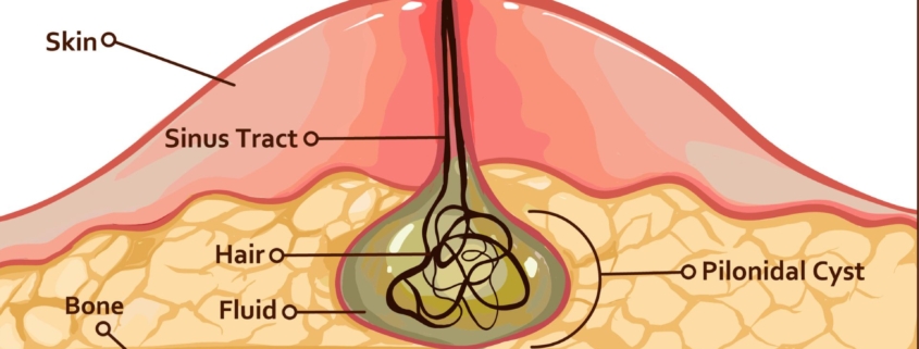 Όταν η “οδυνηρή ουρά” κρύβει κύστη κόκκυγα - Ασκήσεις και Θεραπεία 1 ουρά